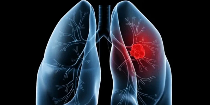 Saiba o que é adenocarcinoma pulmonar, câncer que atinge o Papa Leão XIV
